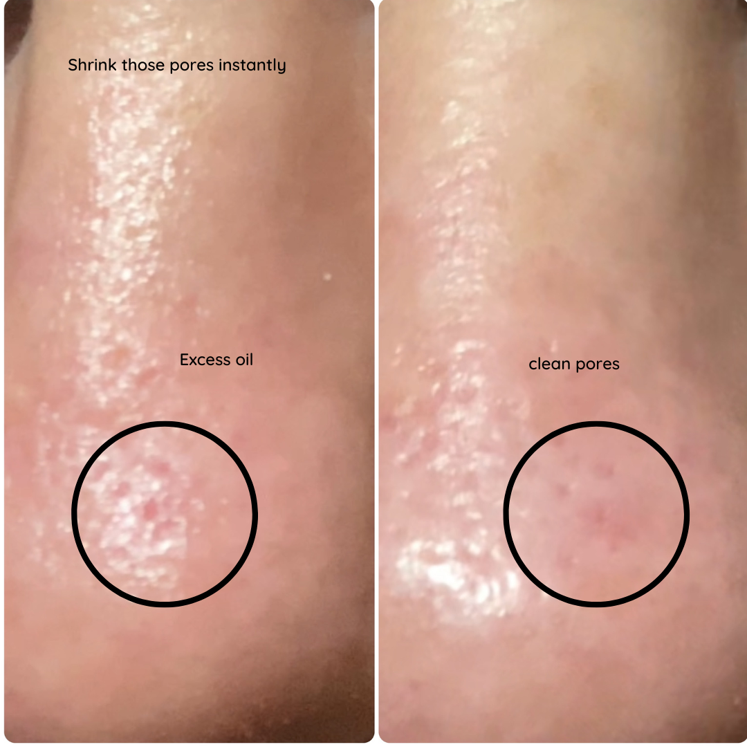 left side pic of enlarged, oil clogged pores. Right side pic of minimised appearance of pores.