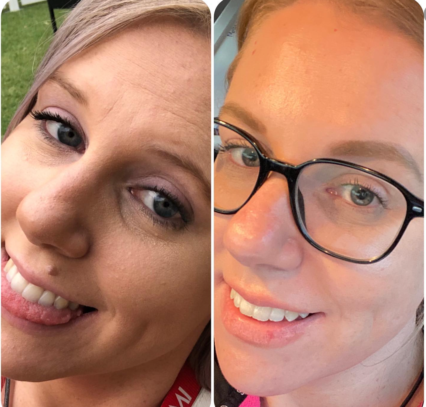 Side by side before and after of Emily luise to show skin difference. Left side textured skin and right side smooth skin. 