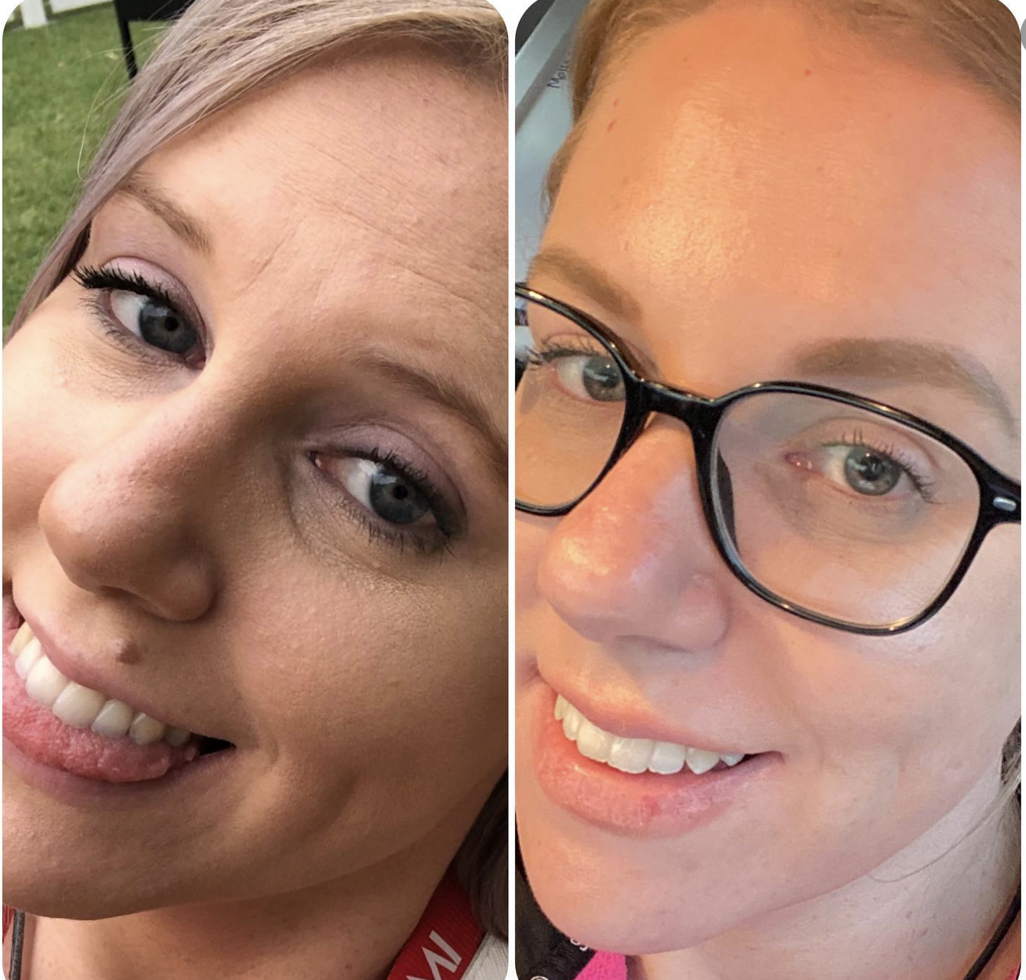 Side by side before and after of Emily luise to show skin difference. Left side textured skin and right side smooth skin. 