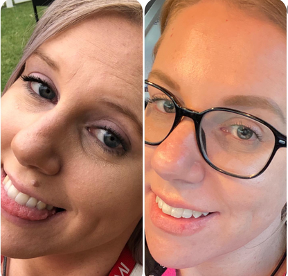 Side by side before and after of Emily luise to show skin difference. Left side textured skin and right side smooth skin. 