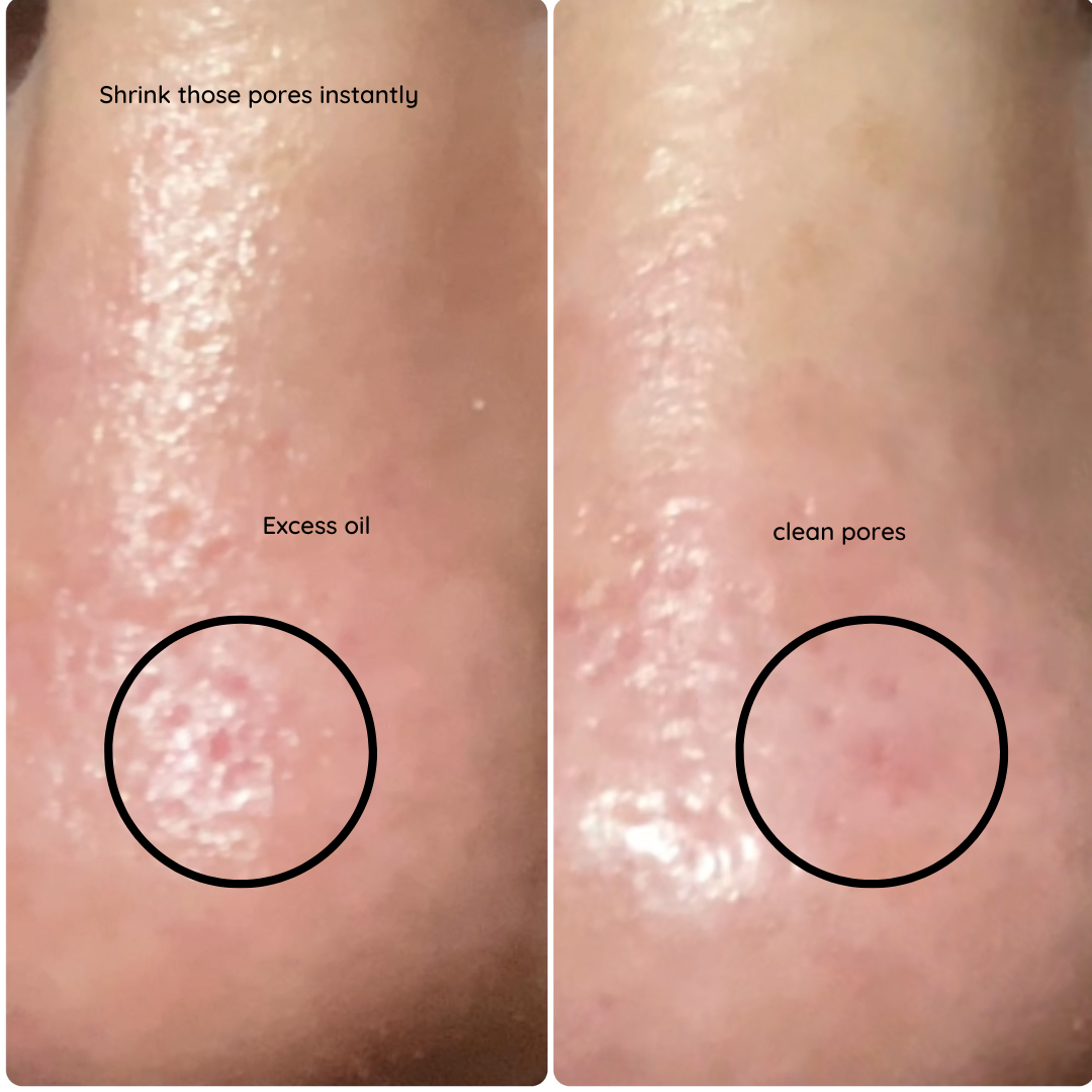 left side pic of enlarged, oil clogged pores. Right side pic of minimised appearance of pores. 